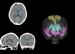 富士フイルムと名古屋市立大学／CT画像上で脳脊髄液腔の各領域を抽出するAI技術を共同開発（26.1.7）