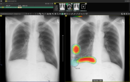 富士フイルム／胸部X線画像病変検出ソフトウェア「CXR-AID Ver3.0」提供開始（26.2.6）